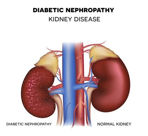 El tratamiento del paciente diabético con nefropatía requiere de una visión global - El médico ...