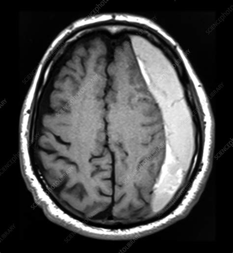 MRI Subdural Hematoma - Stock Image - C043/0393 - Science Photo Library