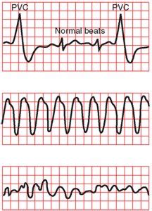 What’s that Rhythm? Making Sense of Abnormal ECG Tracings! with Dr ...