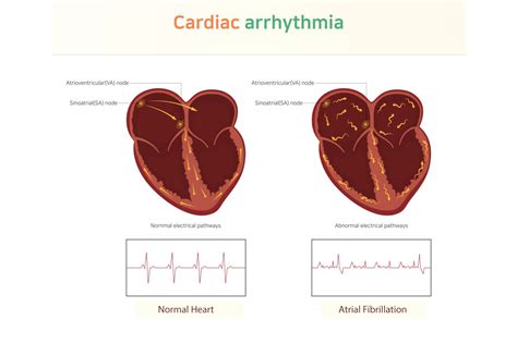 Heart Arrhythmia in Las Cruces