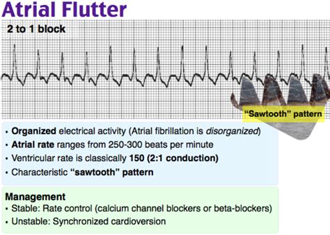 emDOCs.net – Emergency Medicine EducationEM@3AM: Atrial Flutter - emDOCs.net - Emergency ...