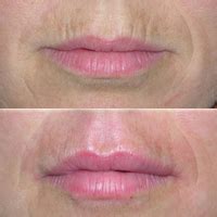 Smoker’s lines filler / Perioral lines filler – MATICLINIC Aesthetics ǀ ...