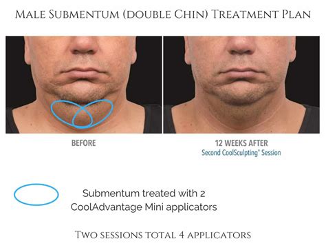 CoolSculpting for Men in Alpharetta & Atlanta, GA - 30% off