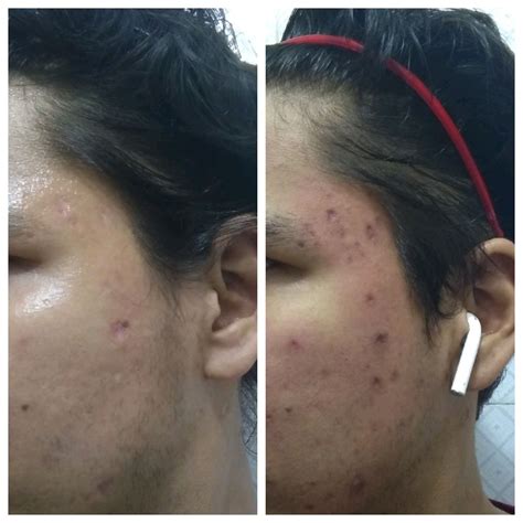 Chicken pox scars after excision.what next? – Scar treatments – Acne.org Forum