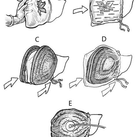 Intraoperative photographs of liver vacuum assisted closure (L-VAC)... | Download Scientific Diagram