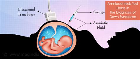 Down Syndrome - Trisomy 21, Causes, Symptoms, Diagnosis, Treatment ...