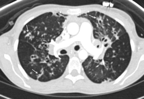 29 year old female with systemic to pulmonary artery shunt in the... | Download Scientific Diagram