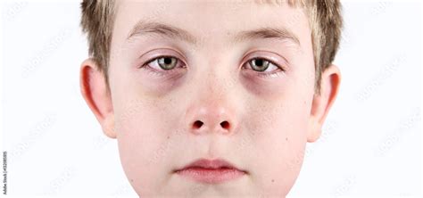 Boy with allergic shiners Stock Photo | Adobe Stock