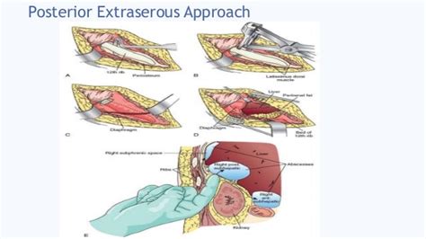 Intra abdominal abscess