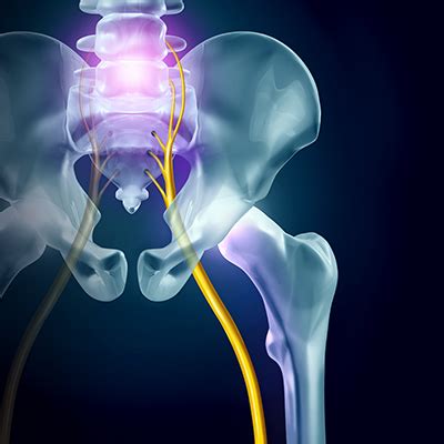 Sacroiliac Joint Dysfunction or Sciatica? Don’t Confuse One for the ...