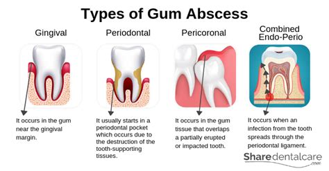 Dental Abscess Types Periapical Gingival Periodontal And Pericoronal ...