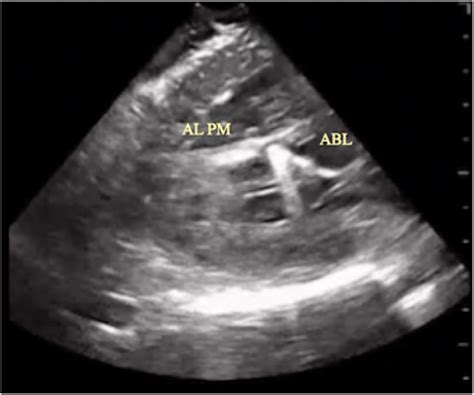 ICE image of PVC ablation. The PVC origin is from the anterolateral ...