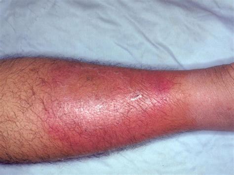 Treatment Options For Cellulitis: Kaminska Dermatology: Dermatologists