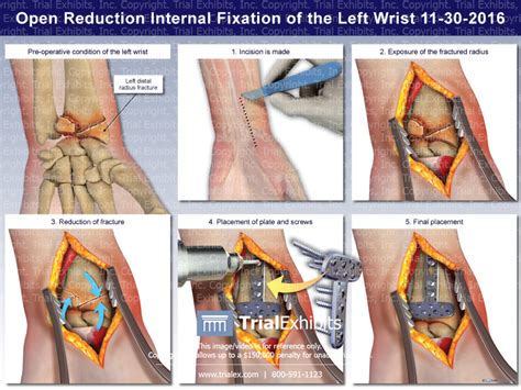 Open Reduction Internal Fixation of the Left Wrist - TrialQuest I...