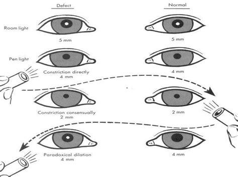 PUPILLARY REFLEXES AND THEIR ABNORMALITIES Optography, 55% OFF