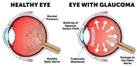 Common Eye Disorders- Symptoms And Treatment