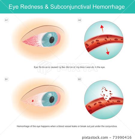 Eye Redness & Subconjunctival Haemorrhage. Eye... - Stock Illustration ...