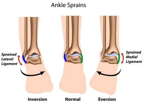 Anterior Talofibular Ligament Sprain