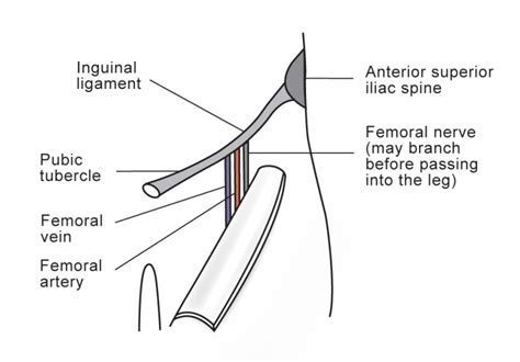 Femoral nerve block