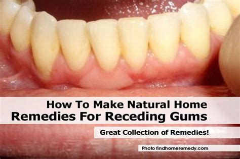 How To Make Natural Home Remedies For Receding Gums