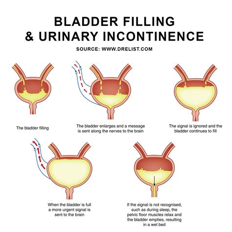 Urinary Incontinence Image | Nursing/Medical Studies | Urinary incontinence, Urinary ...