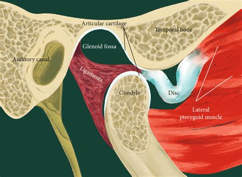 TMJ anterior disc displacement without reduction (ADDwoR). | Download ...