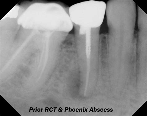 Phoenix Abscess