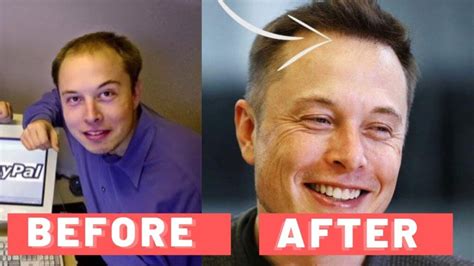 Was Elon Musk Bald? How did Elon Musk grow his hair back? – Belgeard.com