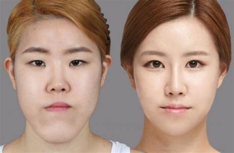 81 photos of plastic surgery in Korea that will make your jaw drop - Stomp