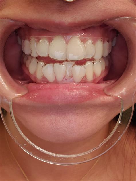 A pic so you can see how the #byte aligners fit. : r/smiledirectclub