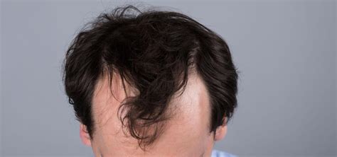 Androgenetic alopecia - treatment, diet - Dr Piotr Turkowski