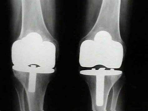 Knee Arthroplasty: Polyethylene Wear : Wheeless' Textbook of Orthopaedics