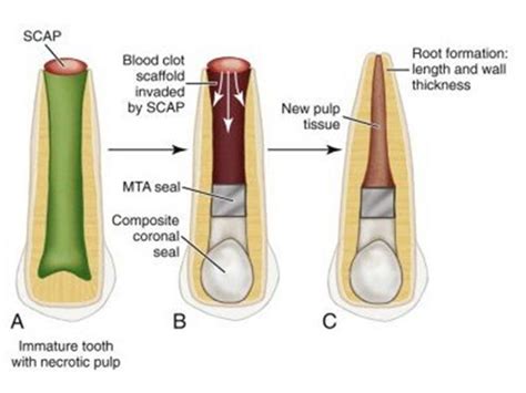 Regenerative endodontic therapy | News | Dentagama