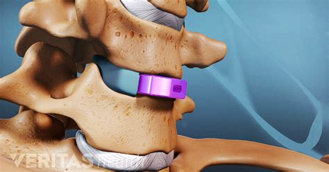 ACDF: Anterior Cervical Discectomy and Fusion