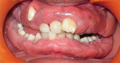 FIBROMATOSIS GINGIVAL : Fibromatosis gingival