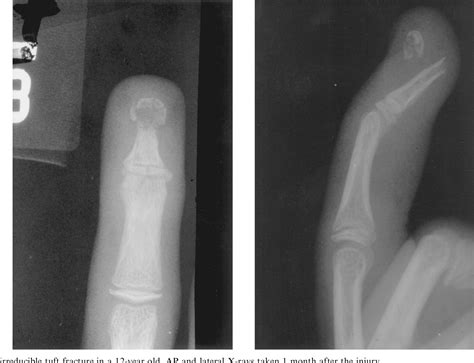 Figure 2 from Irreducible Tuft Fractures of the Distal Phalanx | Semantic Scholar