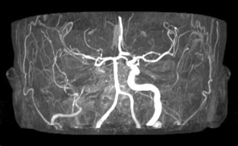 Angio-MRI showing complete right internal carotid artery occlusion in ...