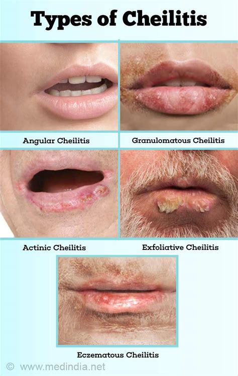 Cheilitis - Causes, Symptoms, Diagnosis & Treatment