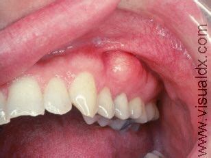 Image of Exostoses, Oral | health | Pinterest | Dental