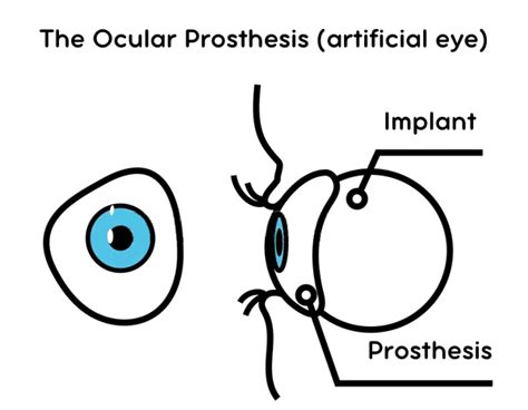 Evisceration - Prosthetic Eye Surgery - Akıllı Lazer Göz Merkezi