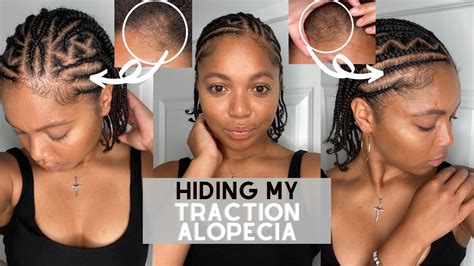 Hiding My Traction Alopecia w/ Cute Natural Braids| Two Layer Braids on Natural 4C Hair - YouTube