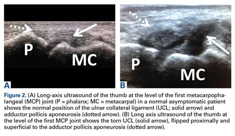 Multimodality Approach to a Stener Lesion: Radiographic, Ultrasound, Magnetic Resonance Imaging ...