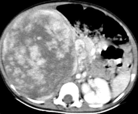 Wilms' tumor CT - wikidoc