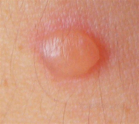 Blood Blisters – Causes, Treatment, Pictures