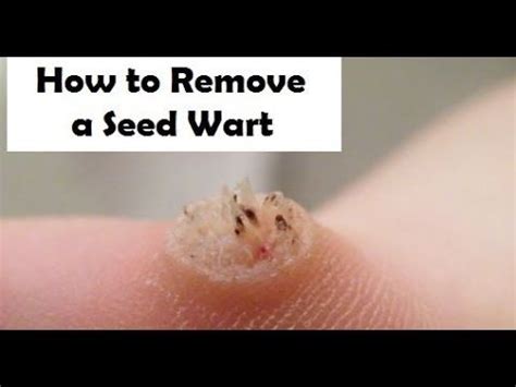 How to remove a seed wart ...If your looking to remove a seed wart make sure you check out: http ...