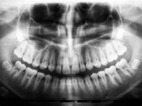 Do Wisdom Teeth Stitches Dissolve or Fall Out? - Qigong Hub