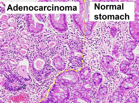 Cáncer Gástrico | Concise Medical Knowledge