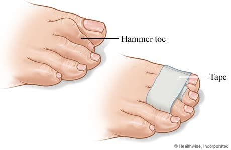 Hammer Toe Causes, Symptoms And Treatment | lavernesanmarco