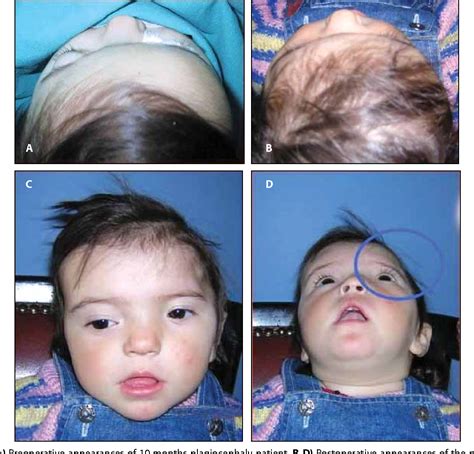 [PDF] The surgical treatment of plagiocephaly. | Semantic Scholar