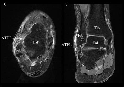 Anterior Talofibular Ligament Mri